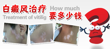 治疗白癜风多少钱